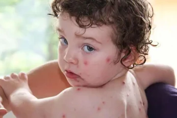 குழந்தைகளை குறிவைக்கும் தக்காளி காய்ச்சல்! அறிகுறிகள் என்னென்ன?