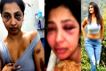 முகம் வீங்கிய நிலையில் பிரபல நடிகை! நடந்த கொடுமை தான் என்ன?