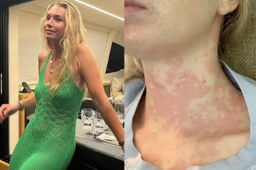 முத்தத்தால் ஏற்படவிருந்த மரணம் - உயிரை பறிக்கும் அளவிற்கு ஏற்பட்ட அரிய நோய்!