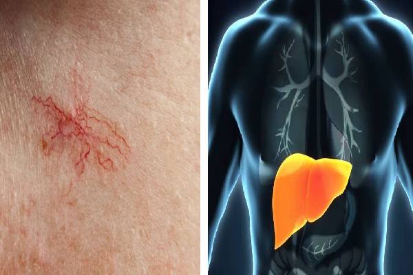 தோலில் இந்த அறிகுறிகள் இருக்கா? அப்போ கல்லீரல் ஆபத்தில் இருக்குதுன்னு அர்த்தம்! | What Are The Warning Signs Of A Damaged Liver