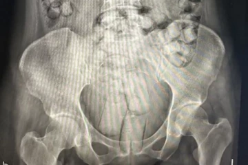 விமான நிலையத்தில் கைது செய்யப்பட்ட இளம்பெண்கள்: எக்ஸ்ரேயில் தெரிந்த அதிர்ச்சி காட்சி