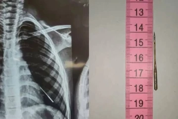 ஊசியை விழுங்கிய சிறுமி - அறுவை சிகிச்சை செய்யாமல் மருத்துவர்கள் செய்த காரியம்?