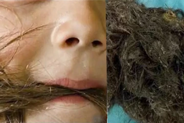 சிறுமியின் வயிற்றில் 3 கிலோ முடி - வெளிவந்த திடுக்கிடும் தகவல்!