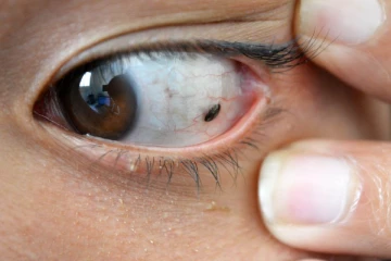 கருவிழியில் மச்சம் இருந்தால் என்ன அர்த்தம்?