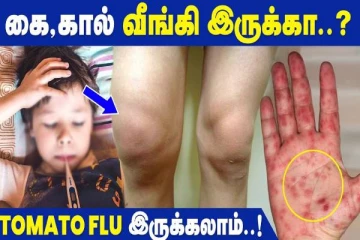கை கால் வீக்கமா? தக்காளி காய்ச்சலின் முக்கிய அறிகுறிகள்