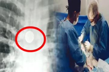 மூச்சுக்குழாயில் சிக்கிய நாணயக்குற்றி 8 ஆண்டுகளுக்கு பின் அகற்றம்!