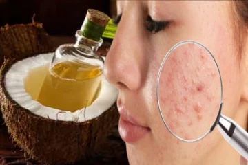 முகப்பருவிற்கு முடிவுகட்ட வேண்டுமா? தேங்காய் எண்ணெயில் இதை கலந்து பூசுங்க