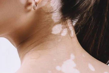 வெண் புள்ளியிலிருந்து விடுதலை வேண்டுமா? இதோ உங்களுக்காக இயற்கை வைத்தியம்