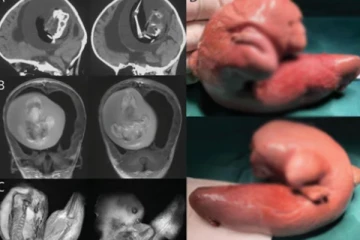 දැරියකගේ මොළයෙන් නූපන් නිවුන් කලලයක් හමුවෙයි.(VIDEO/PHOTOS)