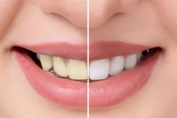 பற்களை எளிதாக வெண்மையாக்குவது எப்படி?