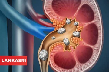 இந்த உணவுகளை சாப்பிட்டா சிறுநீரகத்தில் கல் உருவாகுமாம்... உஷாரா இருங்க...