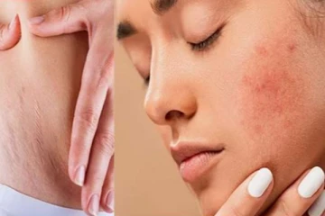 உடலில் தழும்புகளா? இதை ட்ரை பண்ணுங்க போதும்!