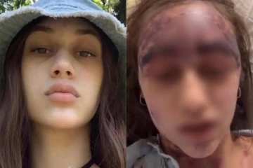 தடுப்பூசி போட்ட இளம்பெண்..அடுத்த சில நொடியில் ஏற்பட்ட ஆபத்து - என்ன காரணம்?