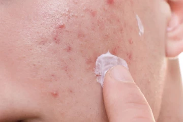 பருக்களால் ஏற்படும் கருமையான தழும்புகளையும் போக்க வேண்டுமா?