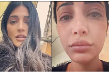 முகம் வீங்கி கண்னீருடன் ஸ்ருதிஹாசன்.. என்னாச்சு - பதறிய ரசிகர்கள்!