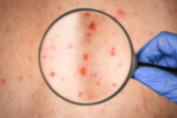 ஈராக்கில் ரத்தக்கசிவு நோயால் பாதிக்கப்பட்ட மக்கள்...18 பேர் உயிரிழப்பு