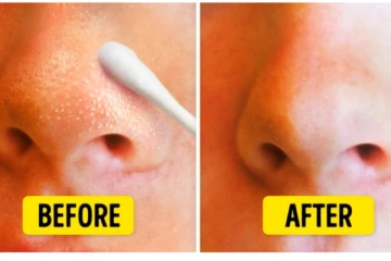 கரும்புள்ளிகளால் நீங்கள் சிரமப்படுகிறீர்களா? இந்த எளிய வீட்டு வைத்தியத்தை முயற்சிக்கவும்