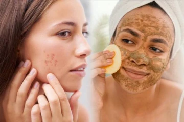 முகத்தில் உள்ள கரும்புள்ளியை நிரந்தரமாக நீக்க உதவும் எளிய வீட்டு வைத்தியம்