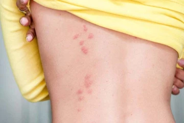 பூச்சி கடித்துவிட்டதா? பயமே வேண்டாம்! வீட்டில் இருக்கும் இந்த பொருள் மட்டும் போதும்