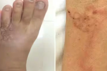 காலின் உட்பகுதியில் நெளிந்த புழுக்களைக் கண்டு அச்சம் அடைந்த பெண் ; பச்சை இரத்த உணவு!!