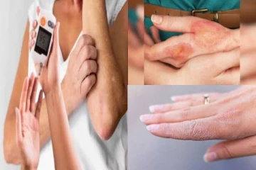 தோலில் இந்த அறிகுறிகள் இருக்கா? அப்போ சுகர் ஏறுதுன்னு தெரிஞ்சிக்கோங்க