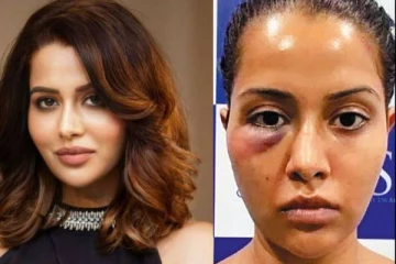 முக அழகை மேம்படுத்த மருத்துவரிடம் சென்ற நடிகை ரைசாவுக்கு நேர்ந்த விபரீதம்! தற்போது அவர் மேற்கொண்ட அதிரடி செயல்