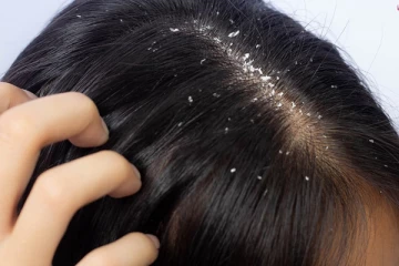 பொடுகு பிரச்சினை உங்களை வாட்டி வதைக்கின்றதா? இதனை போக்க எளிய வழிகள் இதோ