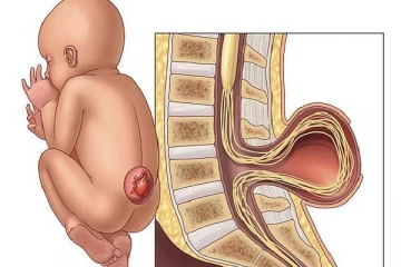 நிஜ வால் பையன்... வெளிநாடு ஒன்றில் 12 சென்றிமீற்றர் நீள வாலுடன் பிறந்த குழந்தை