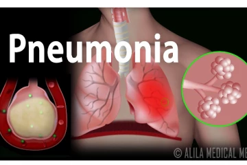 நிமோனியா என்பது என்ன? வீட்டிலேயே குணப்படுத்த முடியுமா?