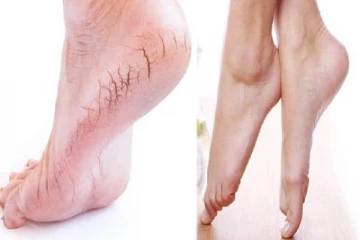 குதிகால் வெடிப்பு அதிகமாக இருக்கா? அப்போ இந்த டிப்ஸ யூஸ் பண்ணுங்க