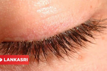 புருவங்கள், கண் இமைகளில் ஏற்படகூடிய பொடுகை எப்படி போக்கலாம்?