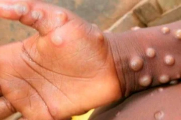 அமெரிக்காவில் பதிவான முதலாவது குரங்கம்மை மரணம்-உலக செய்திகள்