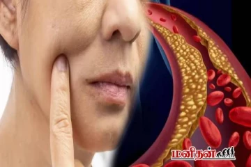 முகத்தில் கொலஸ்ட்ரால் அறிகுறிகள்: உங்கள் கண்களுக்கு கீழ் இப்படி உள்ளதா?