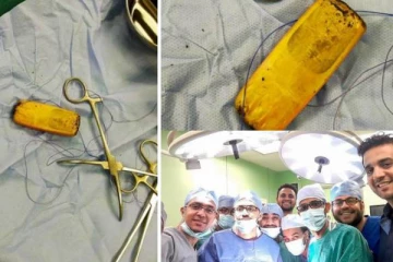 Nokia போனை விழுங்கிவிட்டு... 6 மாதம் கழித்து மருத்துவரை பார்க்க ஓடிய நபர்! எச்சரிக்கை செய்தி