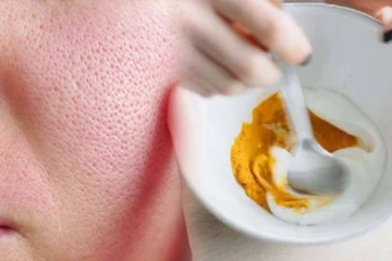 முகத்தில் உள்ள குழிகளை நீக்க உதவும் பேஸ்பேக்.., எப்படி தயாரிப்பது?