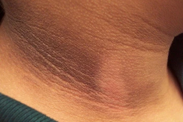 உங்களது கழுத்து கருப்பாக உள்ளதா? இதனை போக்க என்ன செய்யலாம்?