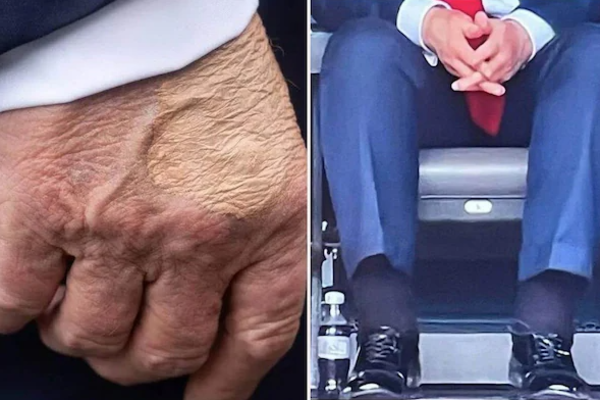 trump cvi Chronic venous insufficiency