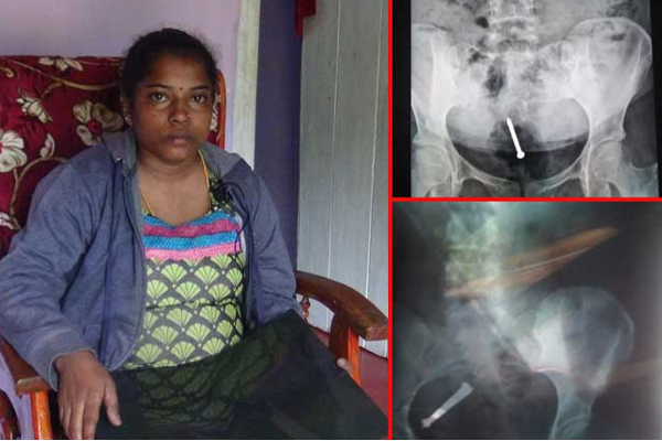 சவுதியில் கொடூரம்: ஆணிகளை விழுங்க வைக்கப்பட்ட இலங்கை பெண் (படங்கள்) | Saudi Sri Lankan Woman Made To Swallow Nails