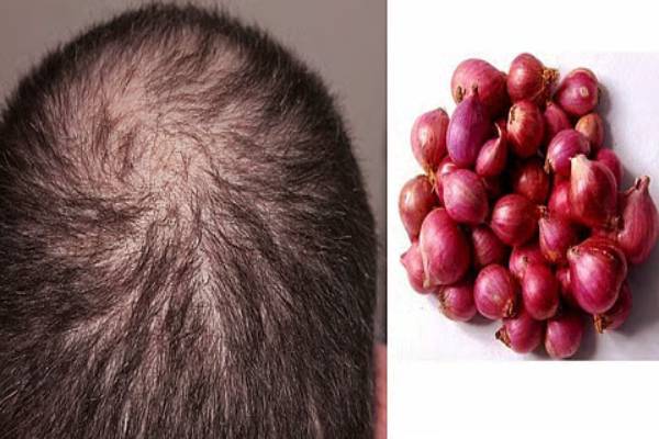 வெங்காய சாறு பயன்படுத்தினால் வழுக்கை தலையிலும் முடி வளருமா? | Using Onion Juice Help Hair Grow On A Bald Head வெங்காய சாறு பயன்படுத்தினால் வழுக்கை தலையிலும் முடி வளருமா? | Using Onion Juice Help Hair Grow On A Bald Head