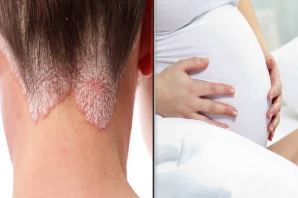 கர்ப்பிணிகளை குறி வைக்கும் சொரியாசிஸ்- எதனால் தெரியுமா? | What Causes Psoriasis In Pregnant Women கர்ப்பிணிகளை குறி வைக்கும் சொரியாசிஸ்- எதனால் தெரியுமா? | What Causes Psoriasis In Pregnant Women