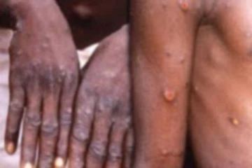 பிரிட்டனில் படையெடுக்கும் குரங்கு காய்ச்சல்...எச்சரித்த சுகாதார அமைச்சு