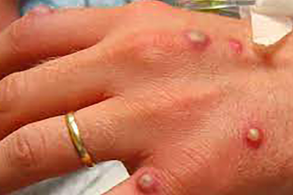 இலங்கையில் மேலும் ஒருவருக்கு குரங்கு அம்மை பாதிப்பு | 2Nd Monkey Pox Patient Detected In Sri Lanka இலங்கையில் மேலும் ஒருவருக்கு குரங்கு அம்மை பாதிப்பு | 2Nd Monkey Pox Patient Detected In Sri Lanka