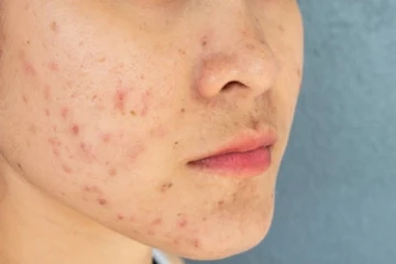 முகத்தில் முகப்பரு அதிகமா வருதா? இதனை மாயமாய் மறைய வைக்க இதோ சில அற்புத வழிகள்!