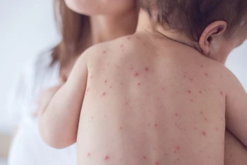 காஸாவில் அச்சமடையும் பொது மக்கள் ; குழந்தைகளிடையே பரவும் தோல் நோய்