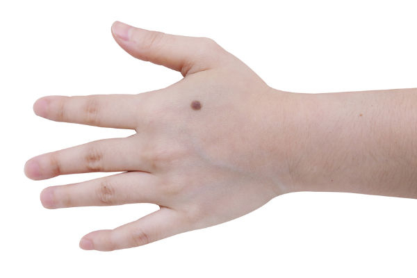 உடம்புல இந்த இடத்துல மச்சம் இருக்கா? யாருக்கும் கிடைக்காத அதிர்ஷ்டம் உங்ககிட்ட இருக்கும்! | Mole Astrology Moles Unravel Your Destiny