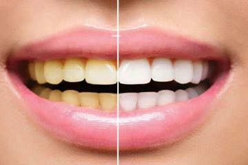 பற்களில் உள்ள மஞ்சள் கறையை நீக்குவது எப்படி ? இதை செய்து பாருங்க!!