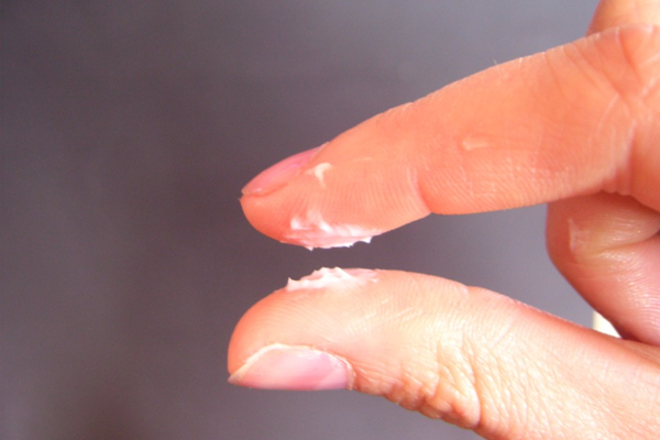 வெள்ளைப்படுதலால் அவஸ்தையா? அலட்சியம் வேண்டாம் | Condition Of Whiteness