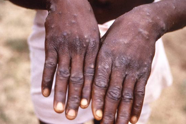 உலகை ஆட்டிப்படைக்கும் ‘குரங்கு அம்மை’ -12 நாடுகளுக்கு பரவியது | Monkeypox 80 Cases Confirmed In 12 Countries