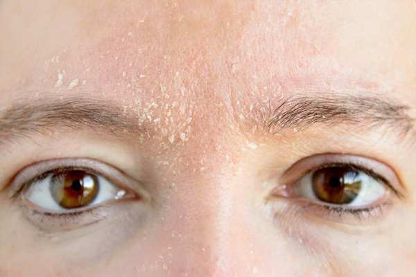 குளிர்காலத்தில் சருமத்தை எவ்வாறு பாதுகாப்பது? இதை கட்டாயம் செய்திடுங்க | Winter Season Skin Itching How To Relieve Prevent குளிர்காலத்தில் சருமத்தை எவ்வாறு பாதுகாப்பது? இதை கட்டாயம் செய்திடுங்க | Winter Season Skin Itching How To Relieve Prevent