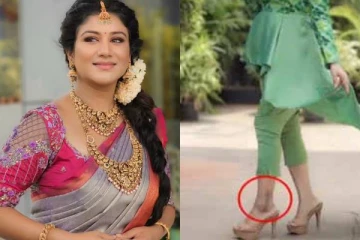 சீரியல் நடிகை ஆல்யாவின் காலில் இவ்வளவு பெரிய தழும்பா!! என்ன காரணம்..